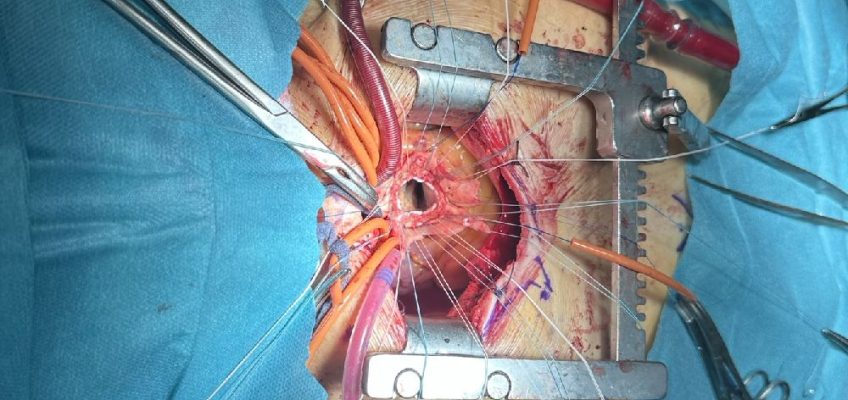 Nove minimalno invazivne procedure u UKC Tuzla