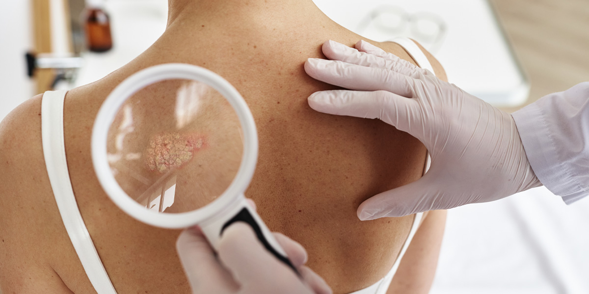 Hemofarm: Psorijaza je više od kože