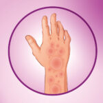 Guba potvrđena u Hrvatskoj, evo da li je izlječiva Guba potvrđena u Hrvatskoj, evo da li je izlječiva