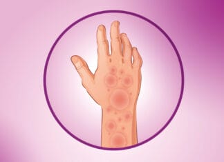 Guba potvrđena u Hrvatskoj, evo da li je izlječiva Guba potvrđena u Hrvatskoj, evo da li je izlječiva