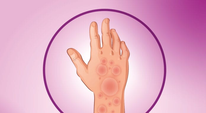 Guba potvrđena u Hrvatskoj, evo da li je izlječiva Guba potvrđena u Hrvatskoj, evo da li je izlječiva