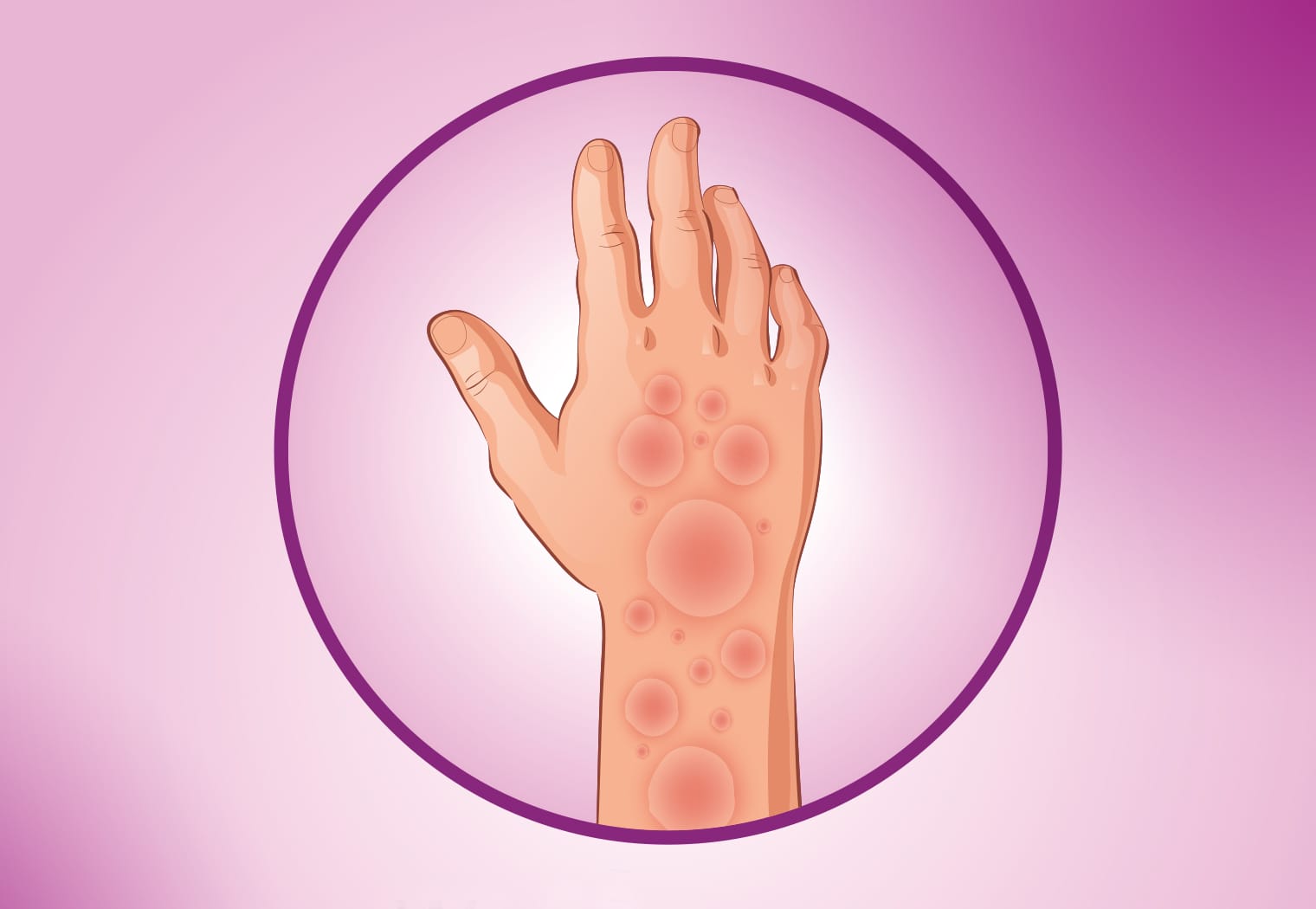 guba Guba potvrđena u Hrvatskoj, evo da li je izlječiva