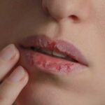 Ispucale usne mogu biti znak ozbiljnog nedostatka u organizmu