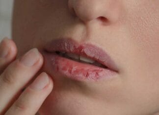 Ispucale usne mogu biti znak ozbiljnog nedostatka u organizmu