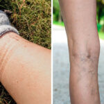 Evo zašto čarape ostavljaju duboke tragove na nogama