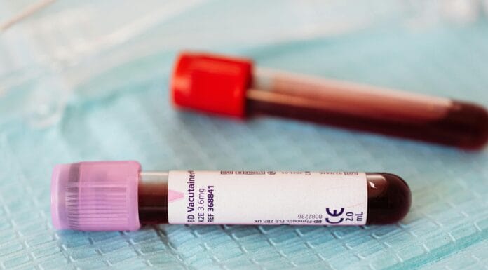 Otkrivena izuzetno rijetka mutacija krvi B(A): novo saznanje koje mijenja transfuzijsku medicinu